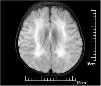 Identification of Two Novel LAMA2 Mutations in a Chinese Patient with Congenital Muscular Dystrophy